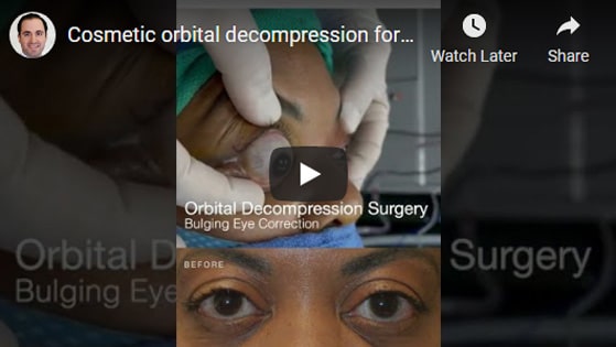 Cosmetic orbital decompression for repair bugling eye