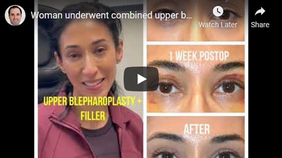Woman underwent combined upper blepharoplasty and upper eyelid filler injection