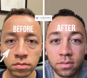 Young man, with genetic under eye fat bags, underwent scarless lower blepharoplasty. Note more youthful eye appearance in his after selfie photo. Note change from double roll to single roll under eyes.
