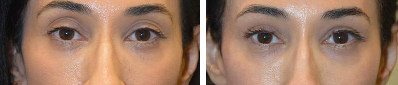 45 year old woman, with upper eyelid aging with loose eyelid skin and fat loss creating sunken hollow upper eyelids, underwent combined upper blepharoplasty and upper eyelid filler injection. Note more rested youthful eye appearance.