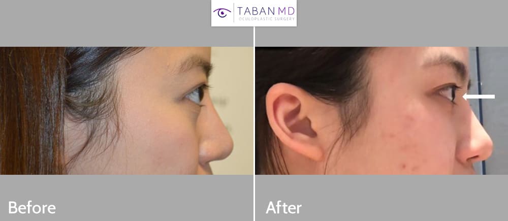 Young Asian female, with genetic bulging eyes, underwent scarless orbital decompression, with quick recovery. She traveled from Asia to Los Angeles for her surgery.