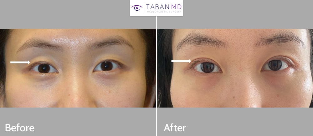 Young Asian woman underwent customized Asian upper blepharoplasty (double eyelid surgery). She traveled from Asia to Los Angeles. Here before and selfie after photos are shown after Asian eyelid surgery.