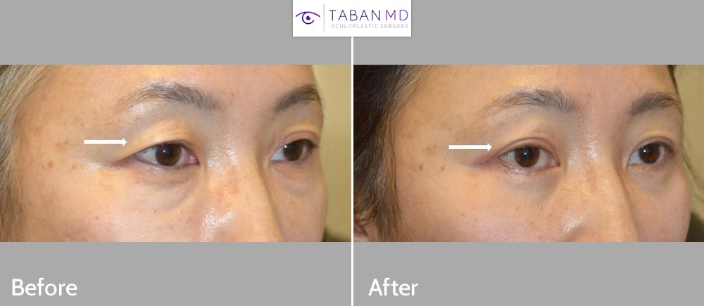 Middle age Asian woman, with upper eyelid aging and asymmetry, underwent customized Asian upper blepharoplasty (double eyelid surgery). Note natural results with improved upper eyelid symmetry after Asian eyelid surgery.