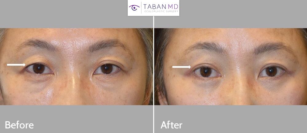 Middle age Asian woman, with upper eyelid aging and asymmetry, underwent customized Asian upper blepharoplasty (double eyelid surgery). Note natural results with improved upper eyelid symmetry after Asian eyelid surgery.