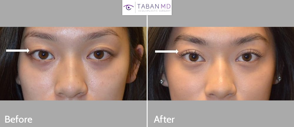 Young Asian woman underwent customized Asian upper blepharoplasty (double eyelid surgery). She traveled from San Jose to Los Angeles. Note improved upper eyelid symmetry.