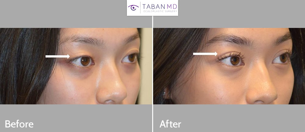 Young Asian woman underwent customized Asian upper blepharoplasty (double eyelid surgery). She traveled from San Jose to Los Angeles. Note improved upper eyelid symmetry.