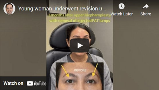 Upper Blepharoplasty and Brow Lift Surgery Click to See Video