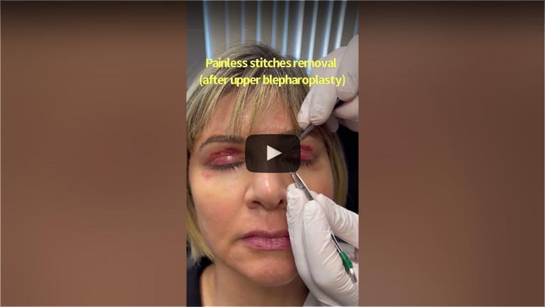 Painless stitches removal after upper blepharoplasty