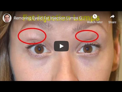 Removing Eyelid Fat Injection Lumps Granulomas