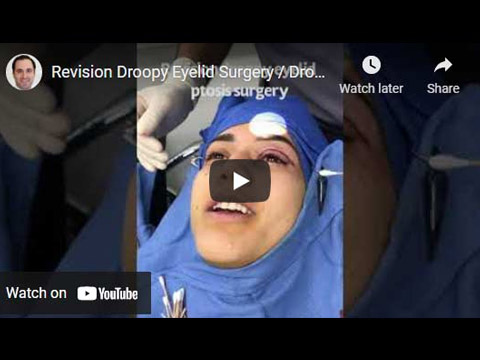 Revision Droopy Eyelid Surgery / Droopy Eyelids Click to see video