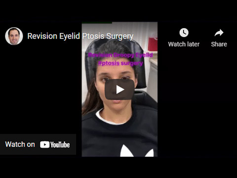 Revision Eyelid Ptosis Surgery Click to See Video