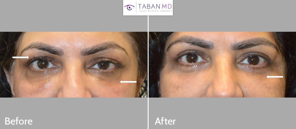 50+ year old woman underwent left droopy upper eyelid ptosis surgery, bilateral upper blepharoplasty and bilateral lower blepharoplasty.