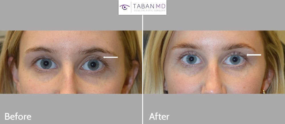 Young woman, with asymmetric upper eyelids, underwent asymmetric upper blepharoplasty and left upper eyelid filler injection. Note improved upper eyelid symmetry.