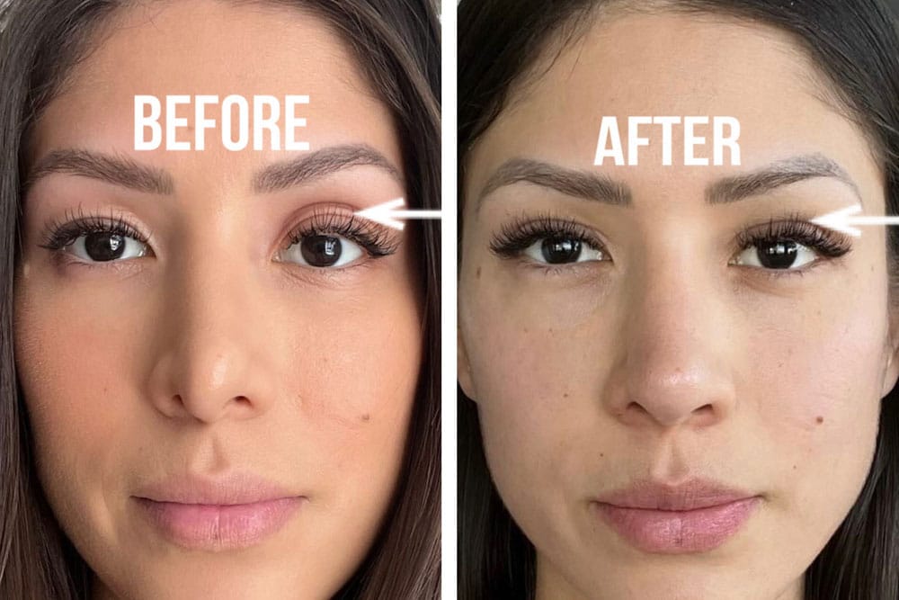Young mother, with asymmetric uneven upper eyelids, underwent customized asymmetric upper blepharoplasty and left upper eyelid filler injection.