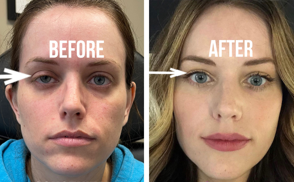 Young woman, with congenital droopy right upper eyelid (ptosis) underwent right scarless ptosis repair. Before and after selfie photo are shown.