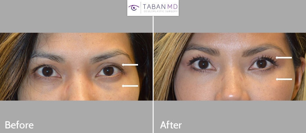 Young woman with complex upper eyelid asymmetry underwent asymmetric upper blepharoplasty, left ptosis surgery, and lower blepharoplasty.