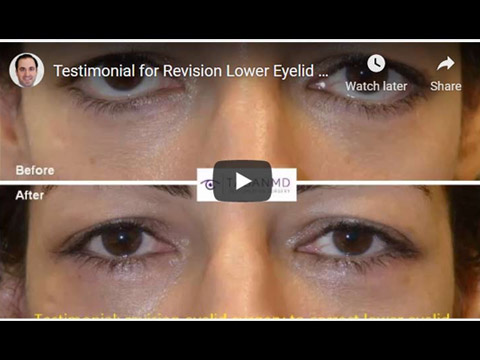 Testimonial for Revision Lower Eyelid Retraction Surgery click to see video
