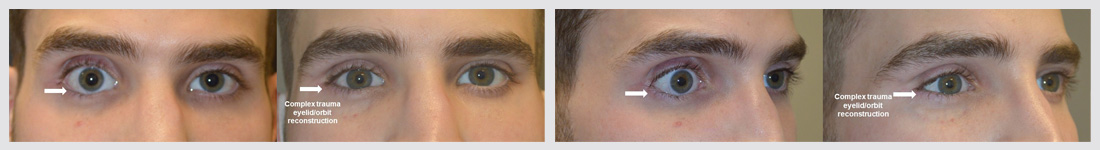 Young man, with severe major right eye trauma, resulting in significant sunken eye and eyelid retraction, who had undergone one previous unsuccessful orbital fracture repair (by another surgeon), underwent revision right orbital implant (removal of old and placement of new implant) plus lower eyelid retraction repair plus upper eyelid filler injection. Note more balanced eye appearance.