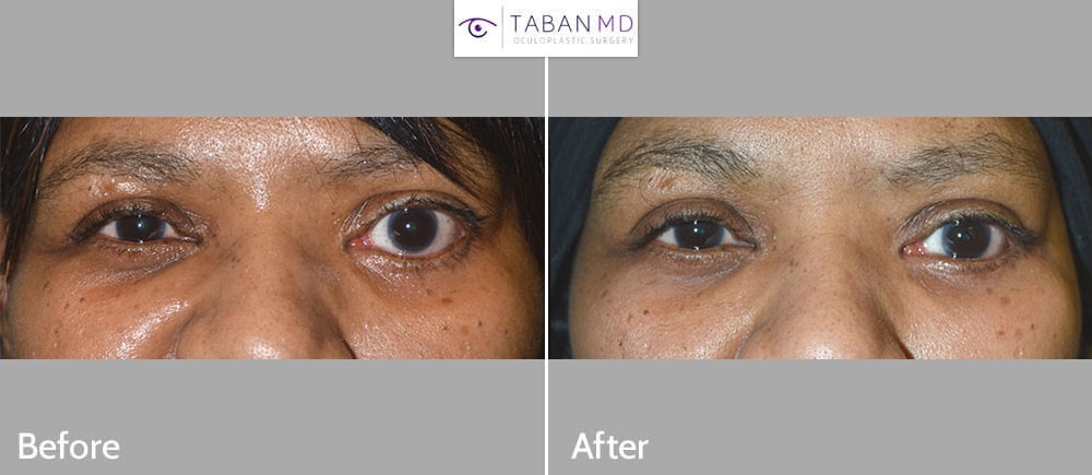 Before obvious eye asymmetry due to severe left lower eyelid retraction. After left lower eyelid retraction with improved eye symmetry.