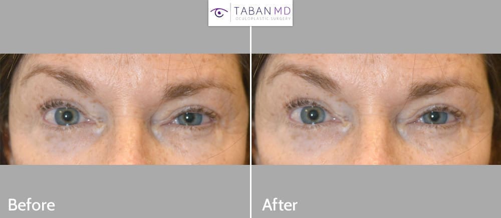 Middle age woman, with both eyelid and eyebrow asymmetry, underwent asymmetric botox injection to create more symmetric eyes.