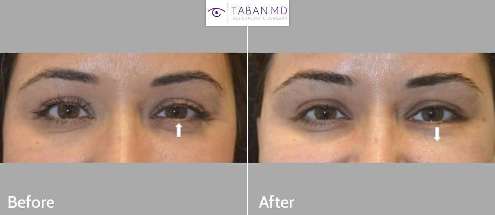 Young woman complained of lower eyelid asymmetry with left lower eyelid higher, especially when smiling. She received botulinum toxin injection in left lower eyelid which created better symmetry during smiling. Before and after treatment photos are shown (during smiling).