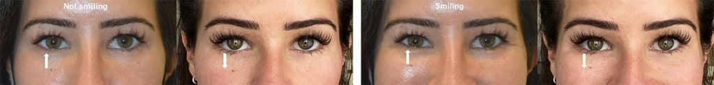 Beautiful young woman with lower eyelid asymmetry (right lower eyelid higher, especially during smiling) underwent right lower eyelid botulinum toxin injection. Note improved lower eyelid symmetry, both at rest and during smiling.
