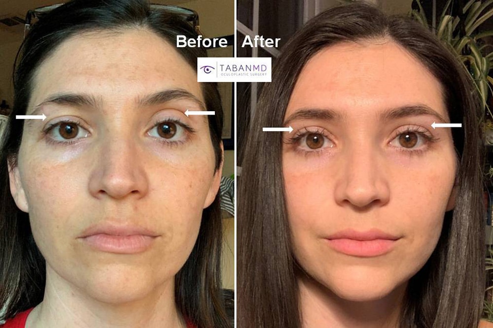 Beautiful young woman with upper eyelid asymmetric underwent customized upper blepharoplasty and upper eyelid filler injection. Note improved eye symmetry.