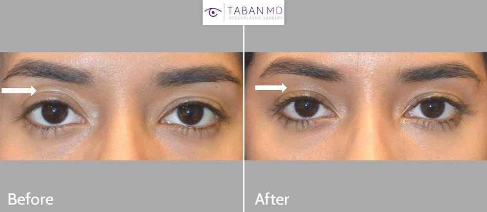Young woman, complained of upper eyelid asymmetry with hollow sunken right upper eyelid with loose extra skin folds. She received right upper eyelid filler injection. Note improved eye symmetry.