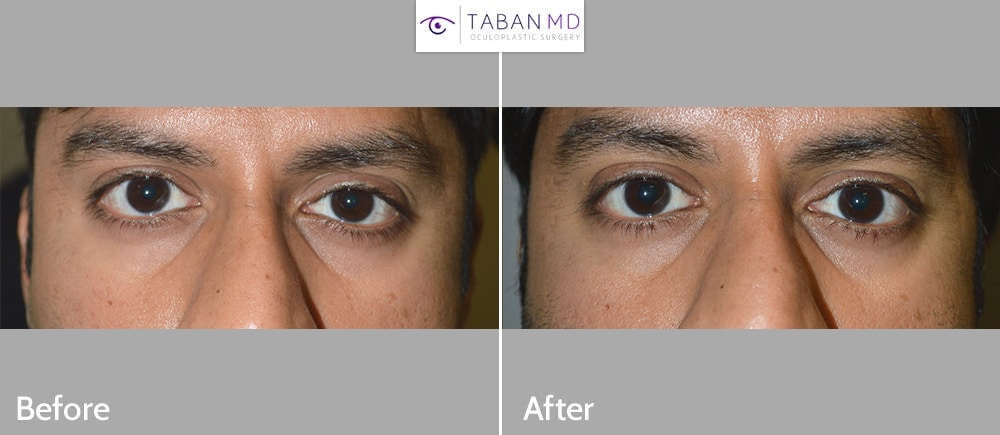 Before eye asymmetry due to mild right upper eyelid retraction. After right upper eyelid retraction surgery with improved eye symmetry.