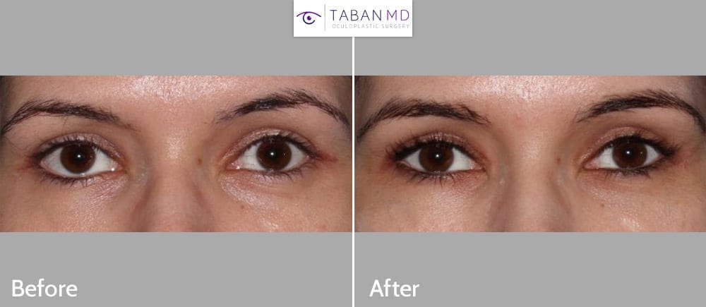 After – bilateral lower eyelid retraction surgery, right side greater, with improved eye symmetry.