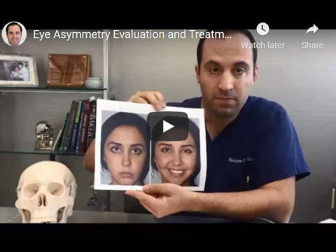 Eye Asymmetry Evaluation and Treatment Guide by Dr. Taban click to see video