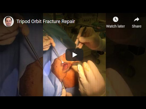 Tripod Orbit Fracture Repair click to see video