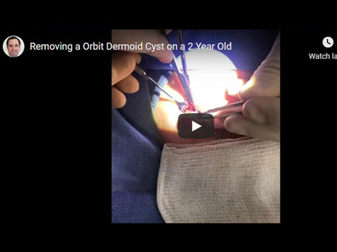 Removing a Orbit Dermoid Cyst on a 2 Year Old click to see video