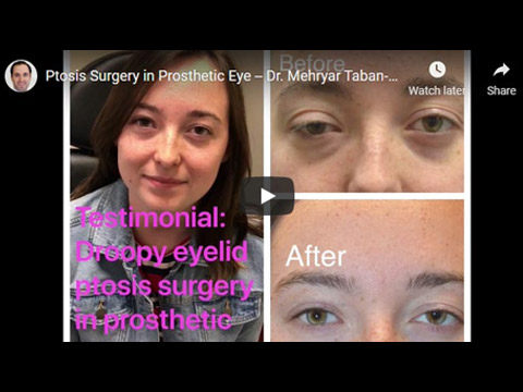 Ptosis Surgery in Prosthetic Eye -- Dr. Mehryar Taban click to see video