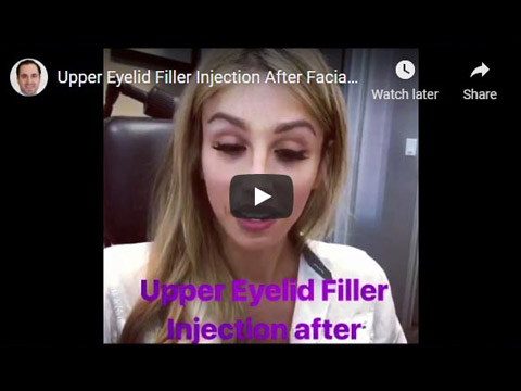 Upper Eyelid Filler Injection After Facial Feminization Surgery click to see video