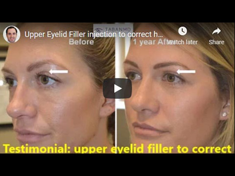 Upper Eyelid Filler injection to correct hollowness after upper blepharoplasty click to see video