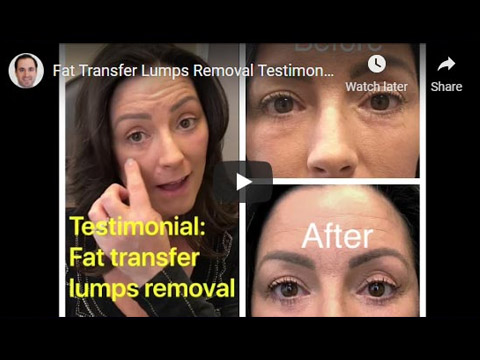 Fat Transfer Lumps Removal Testimonial -- Dr. Mehryar Taban click to see video