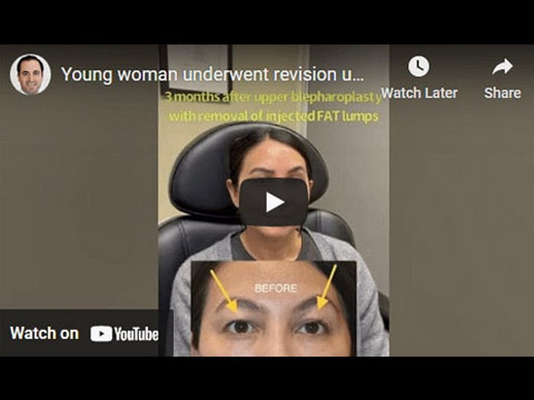 Young woman underwent revision upper blepharoplasty click to see video