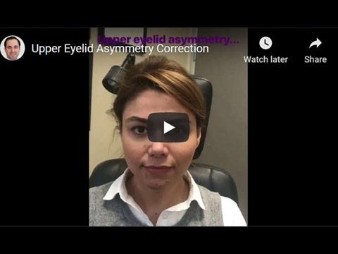Upper Eyelid Asymmetry Correction click to see video