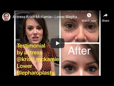 Actress Kristi McKamie-- Lower Blepharoplasty Testimonial click to see video