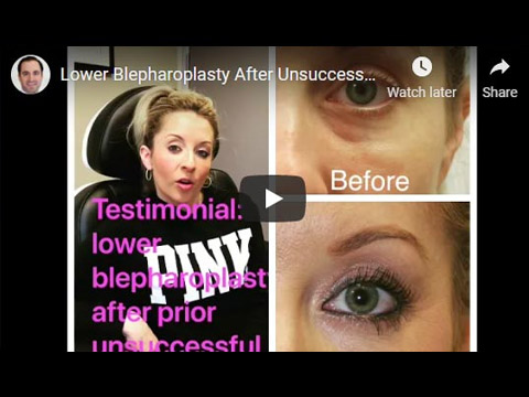 Lower Blepharoplasty After Unsuccessful Filler Testimonial click to see video