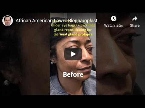 African American Lower Blepharoplasty click to see video