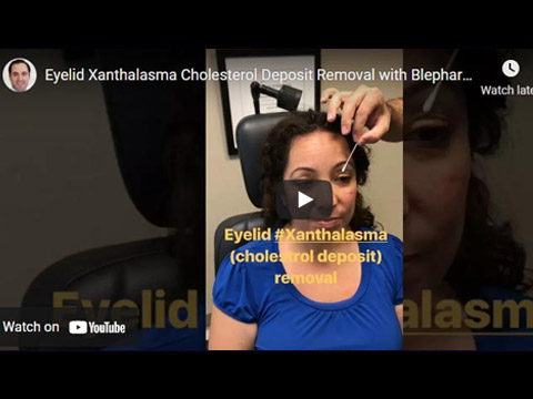 Eyelid Xanthalasma Cholesterol Deposit Removal with Blepharoplasty click to see video