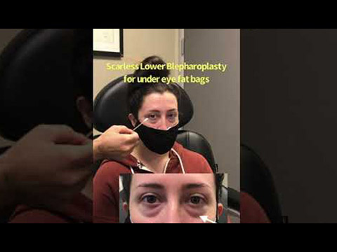 Beautiful woman with under eye fat bags, underwent scarless lower blepharoplasty click to see video