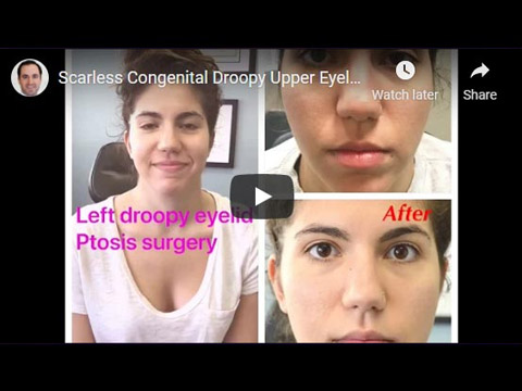 Scarless Congenital Droopy Upper Eyelid Ptosis Surgery in a young woman click to see video