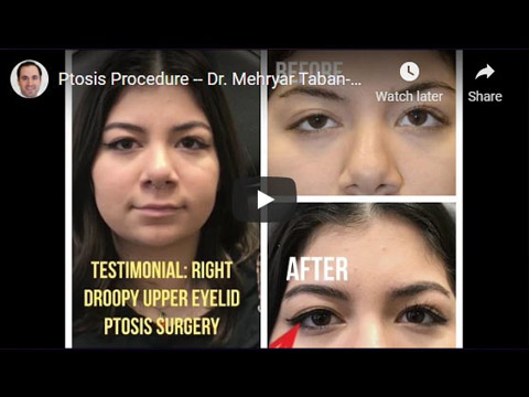 Ptosis Procedure click to see video