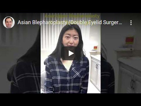 Asian Blepharoplasty (Double Eyelid Surgery) Taban MD click to see video