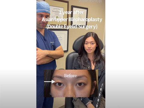 Double Eyelid Surgery click to see video