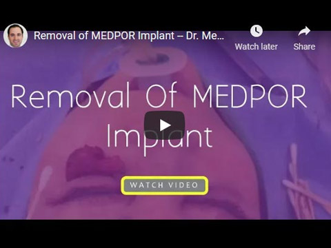 Removal of MEDPOR Implant click to see video