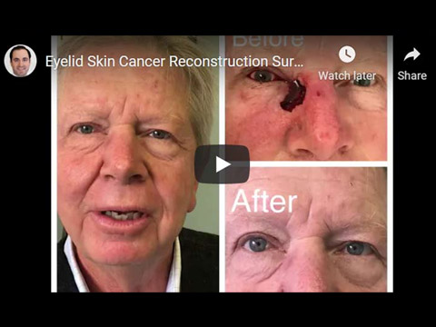 Eyelid Skin Cancer Reconstruction Surgery click to see video